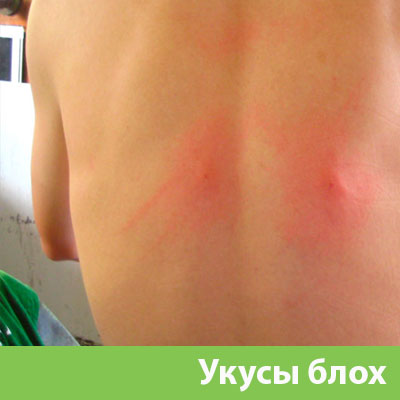 Укусы блох в Клинцах