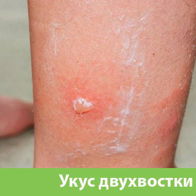 Укус двухвостки в Клинцах