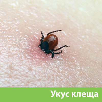 Укус клеща в Клинцах