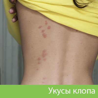 Профессиональное уничтожение клопов в Клинцах